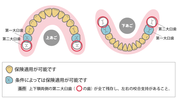 保険でできるリーズナブルな白いかぶせ物